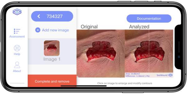 SeeWound is an easy-to-use mobile app for monitoring wound healing. It is one of the special techniques that CTC uses in clinical trials related to hard-to-heal wounds.